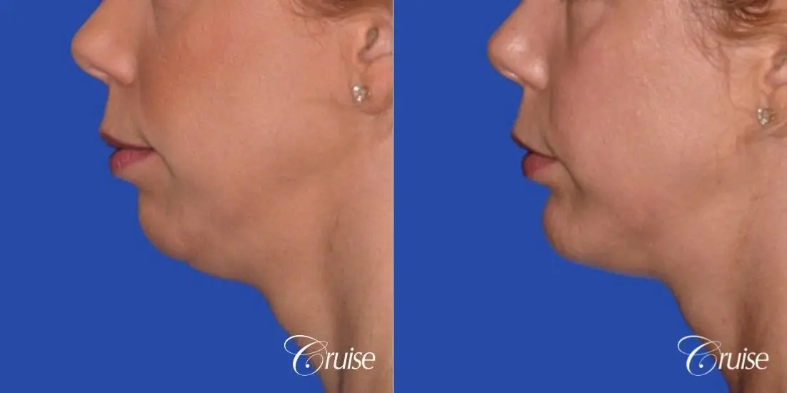 best medium anatomic chin implant on female - Before and After 2