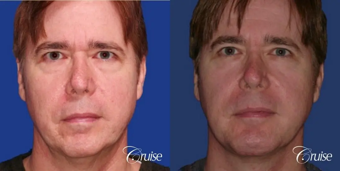 male with best scar for chin implant - Before and After 1