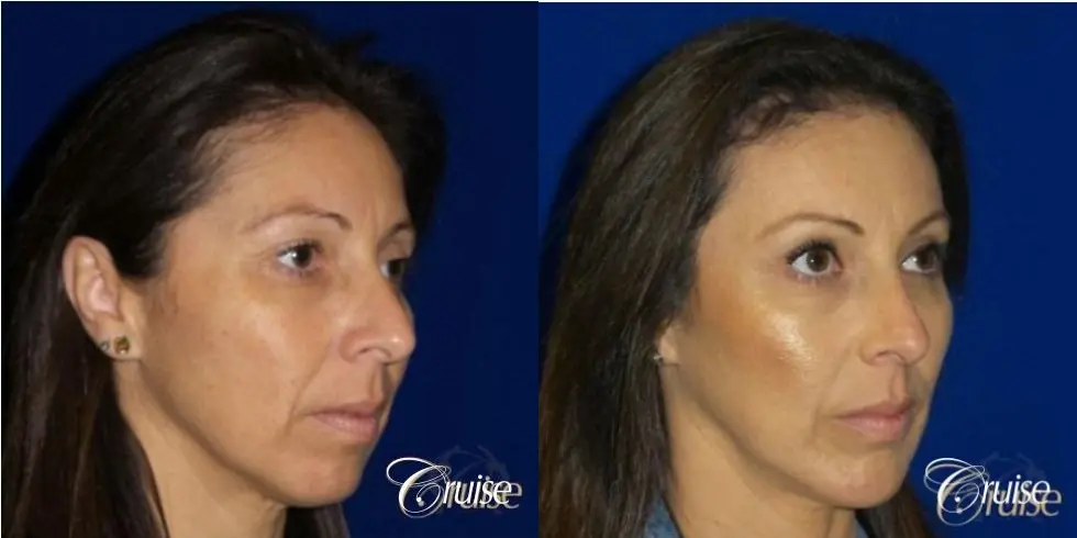 Chin Augmentation -Extra Large Anatomic Implant - Before and After 3
