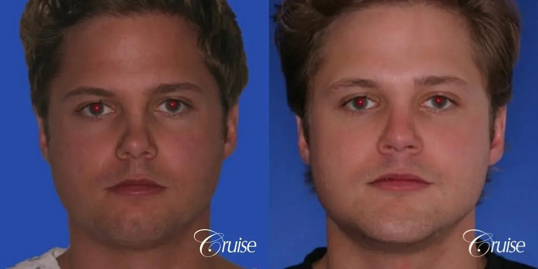 young male with best chin augmentation - Before and After 1