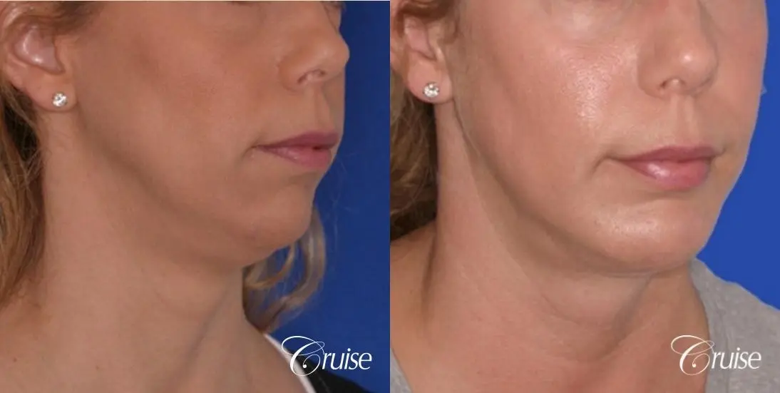 best medium anatomic chin implant on female - Before and After 3
