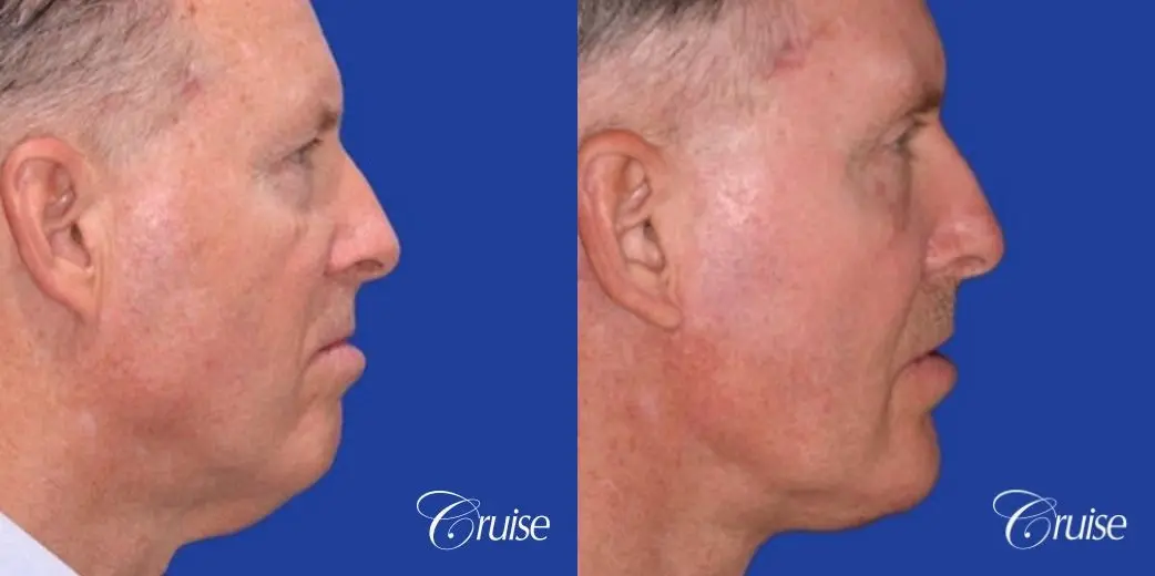 62 year old with chin implant and neck lift - Before and After 3