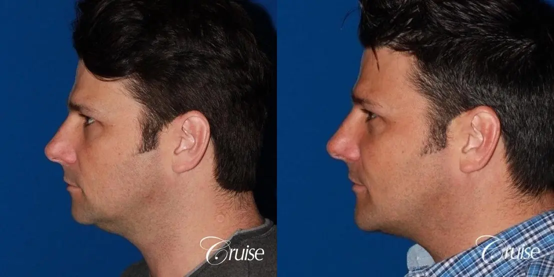 best medium terino square implant before and after pictures - Before and After 2