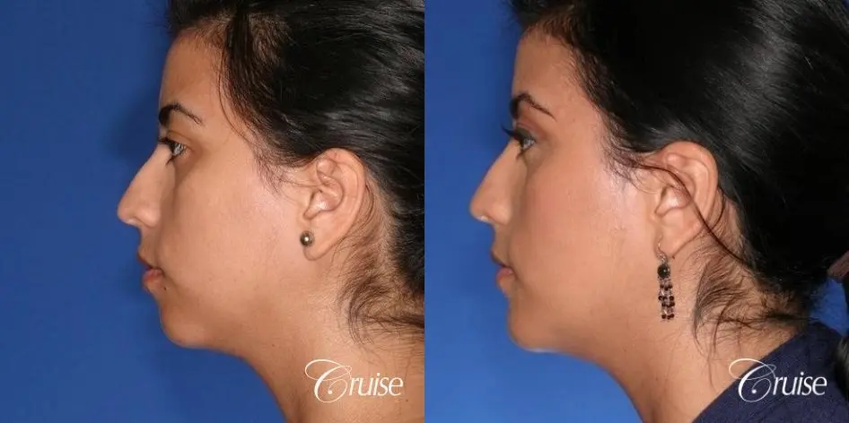 best XL chin implant on female patient - Before and After 2