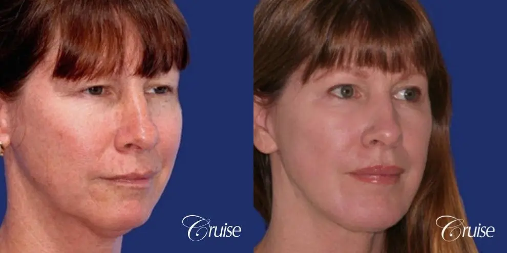 52 year old with chin augmentation and facelift - Before and After 2