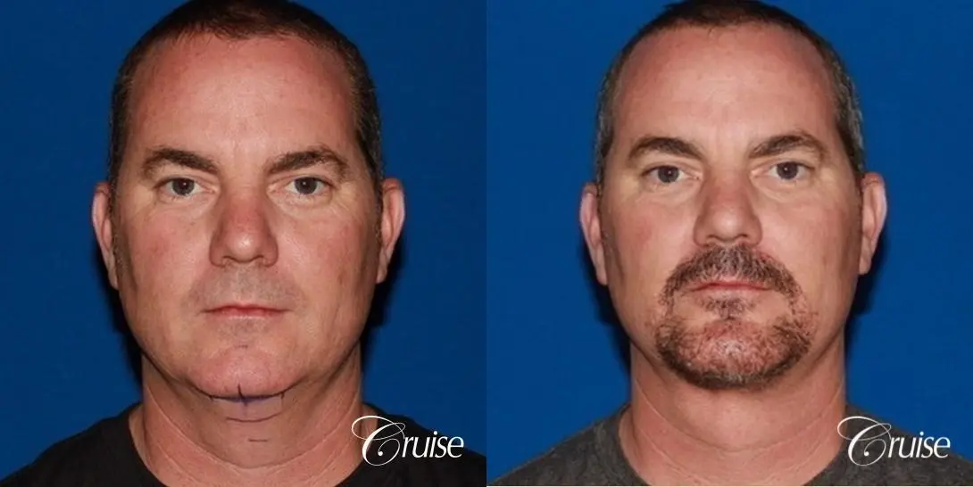 best pictures of chin augmentation with specialist - Before and After 1