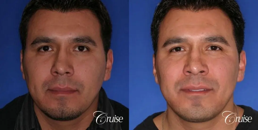 chin augmentation orange county - Before and After 1