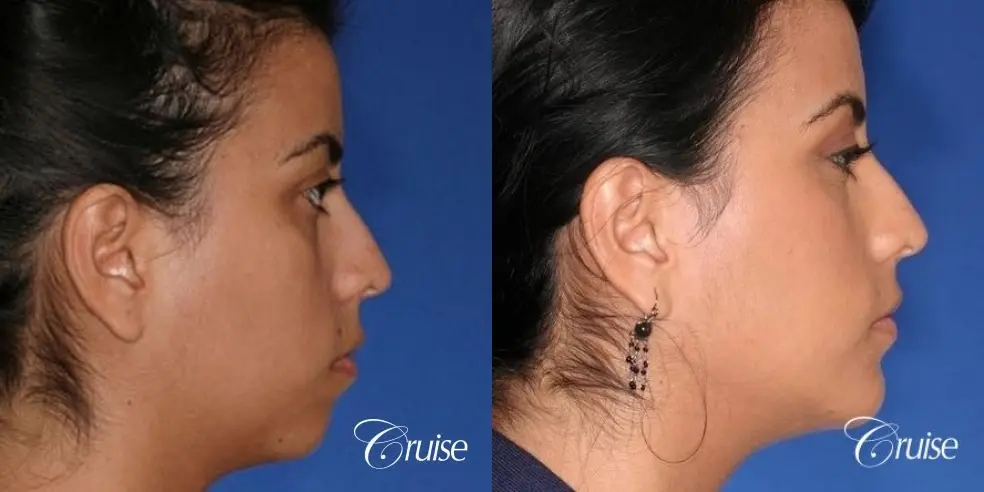 best XL chin implant on female patient - Before and After 4