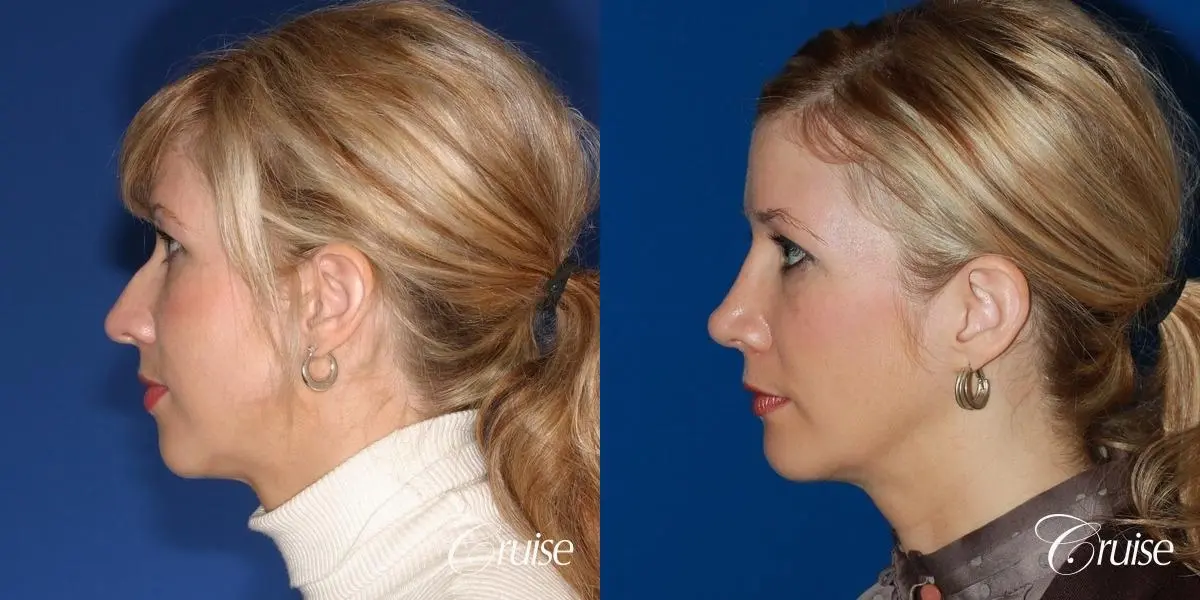 female patient with best chin implant scar - Before and After 2