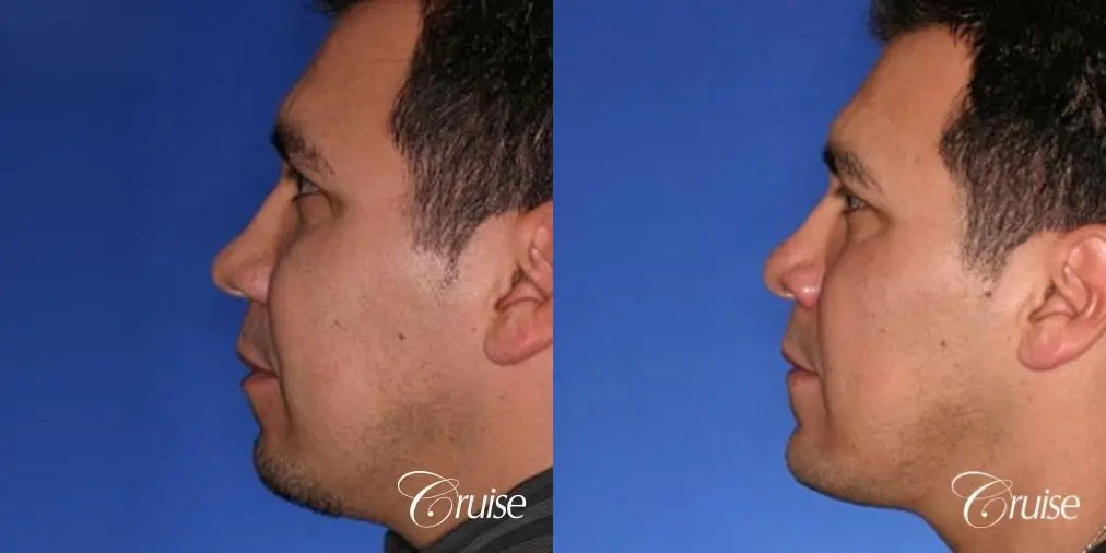 chin augmentation orange county - Before and After 2