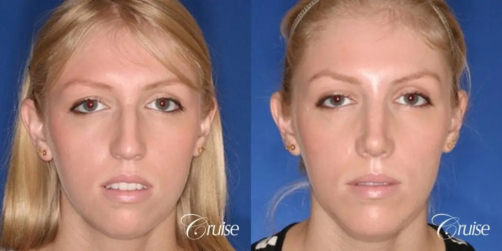 young female with large anatomic chin implant - Before and After 1