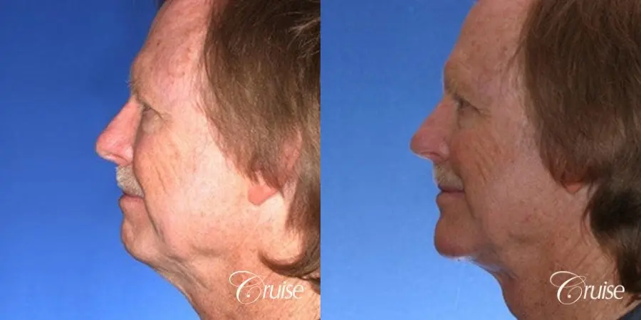 62 yr old with medium square chin augmentation - Before and After 2
