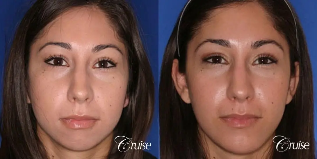 anatomic chin implant with top plastic surgeon in Newport Beach - Before and After 1
