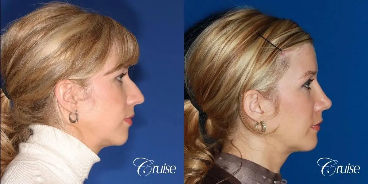 female patient with best chin implant scar - Before and After 4