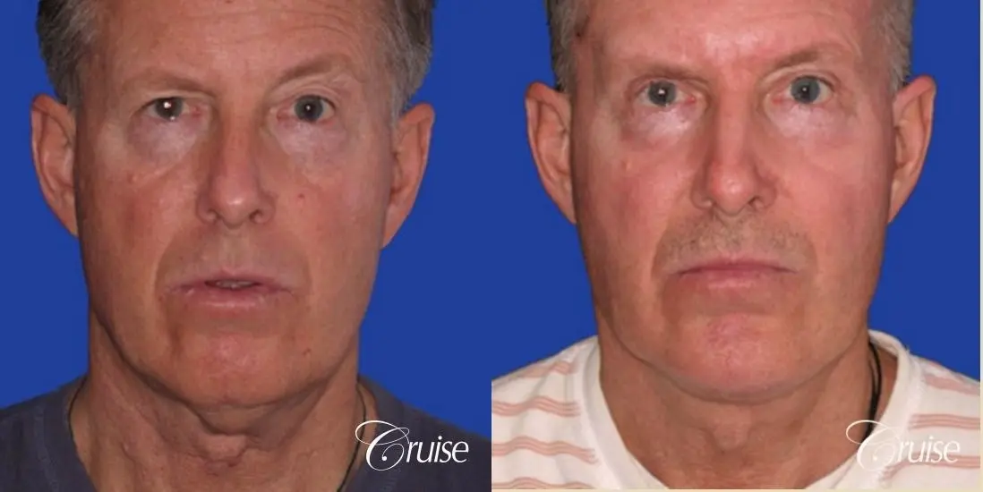 62 year old with chin implant and neck lift - Before and After 1