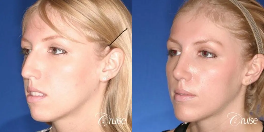 young female with large anatomic chin implant - Before and After 3