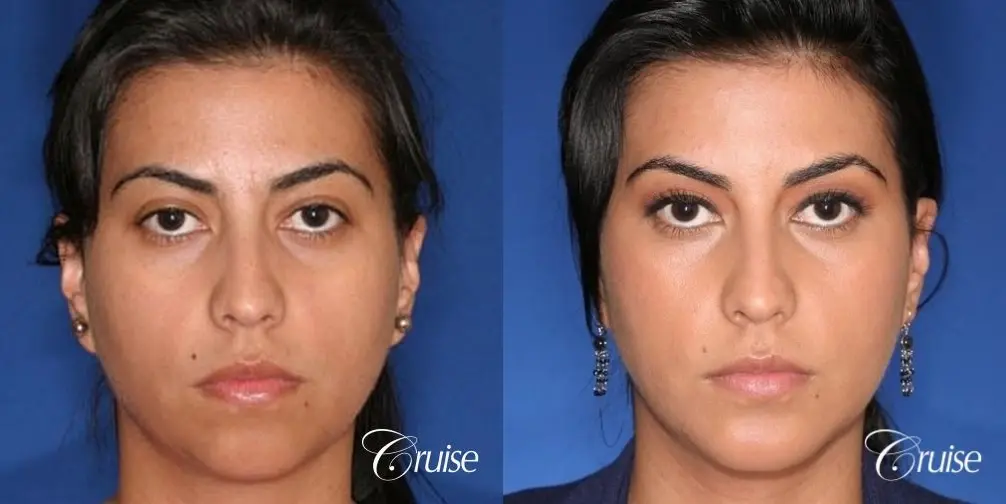 best XL chin implant on female patient - Before and After 1