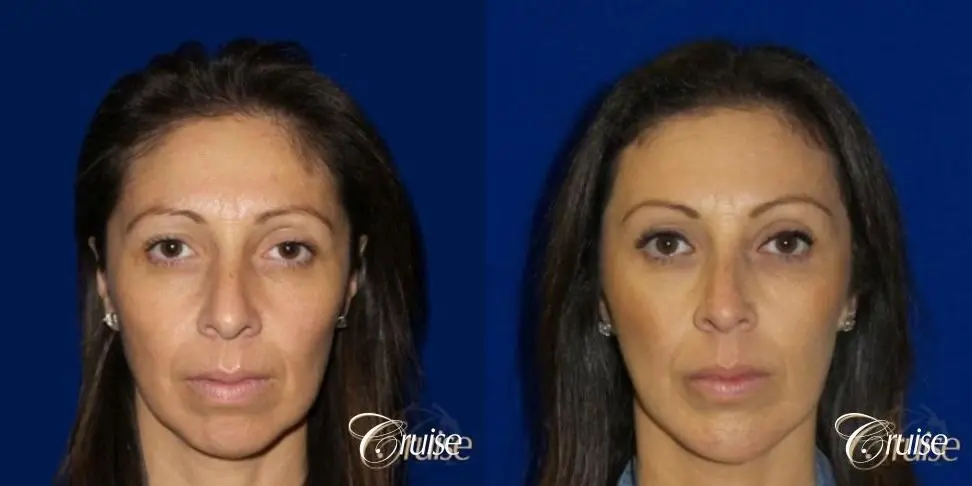 Chin Augmentation -Extra Large Anatomic Implant - Before and After 1