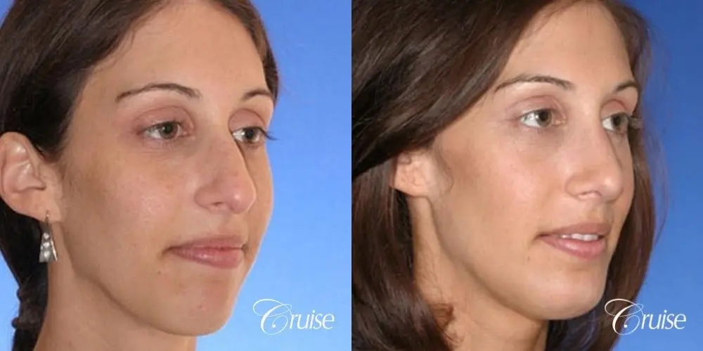 29 yr old with large female chin augmentation - Before and After 3