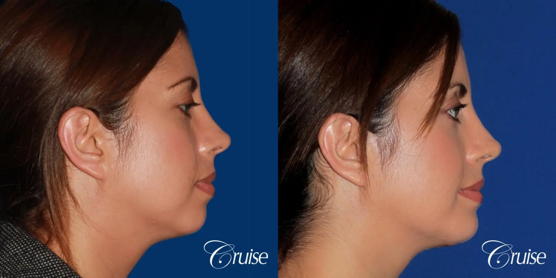 woman with large anatomic chin implant - Before and After 3