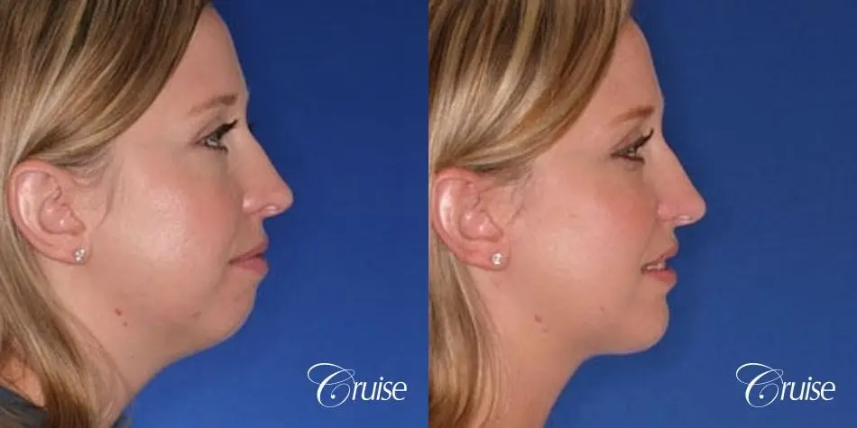 best plastic surgeon for chin augmentation implant - Before and After 2