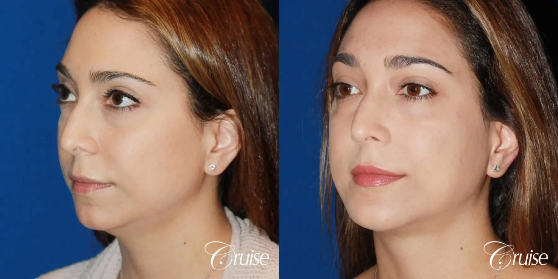 best medium chin implant on young patient - Before and After 3
