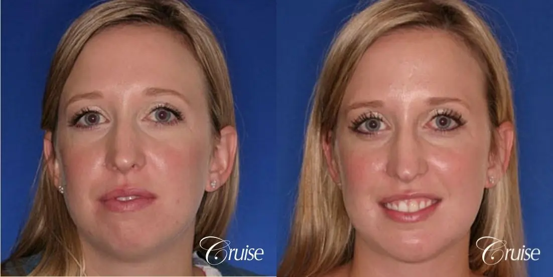best plastic surgeon for chin augmentation implant - Before and After