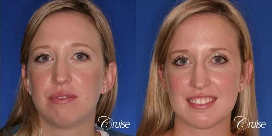 best plastic surgeon for chin augmentation implant - Before and After 1