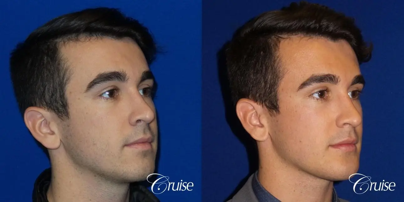 Best chin augmentation pictures for men - Before and After 2