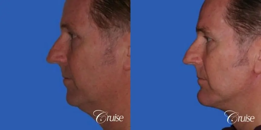 52 yr old male with medium square chin implant - Before and After 2