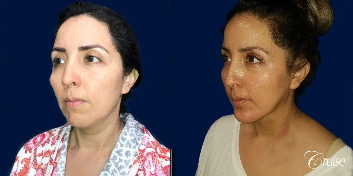 Chin Augmentation Large Anatomic Implant - Before and After 3