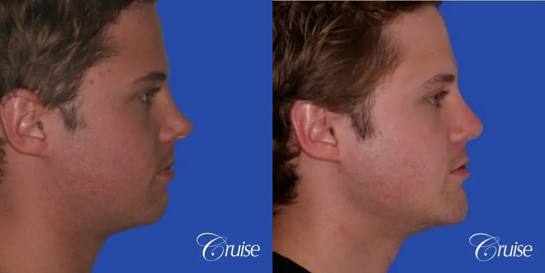 young male with best chin augmentation - Before and After 2