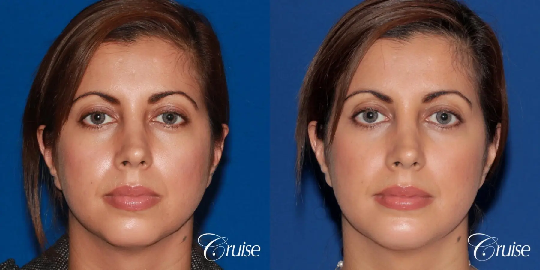 woman with large anatomic chin implant - Before and After 1