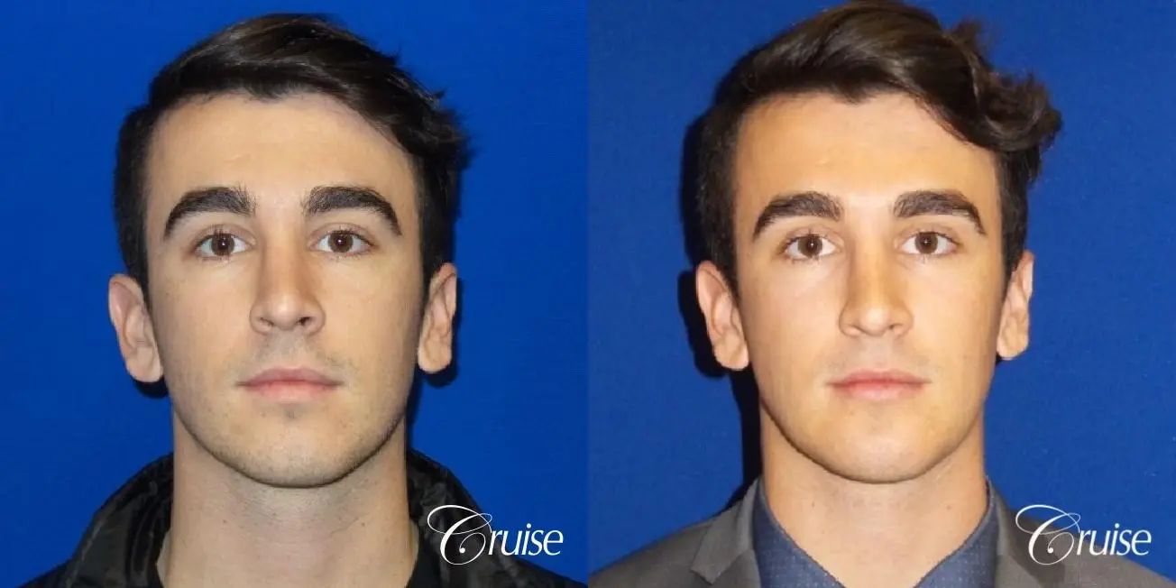 Best chin augmentation pictures for men - Before and After