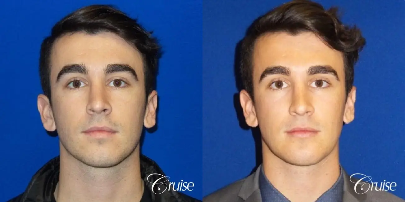 Best chin augmentation pictures for men - Before and After 1