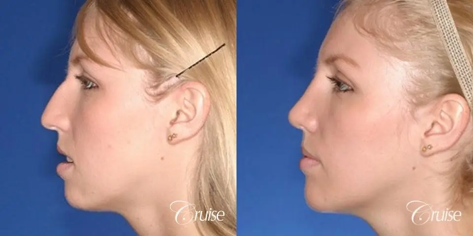 young female with large anatomic chin implant - Before and After 2