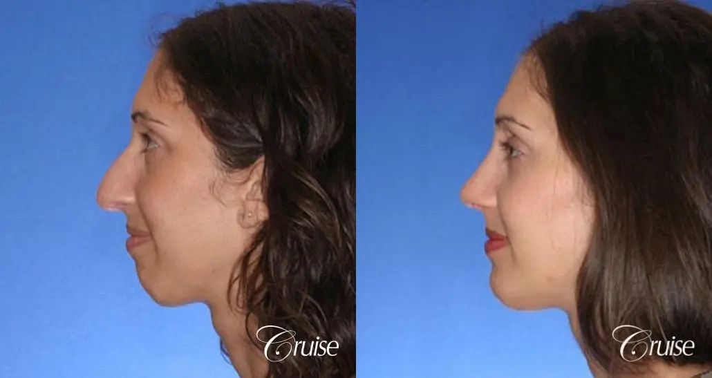29 yr old with large female chin augmentation - Before and After 2