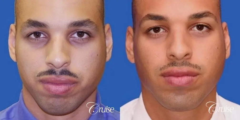 male patient with best pictures of chin implant - Before and After 1