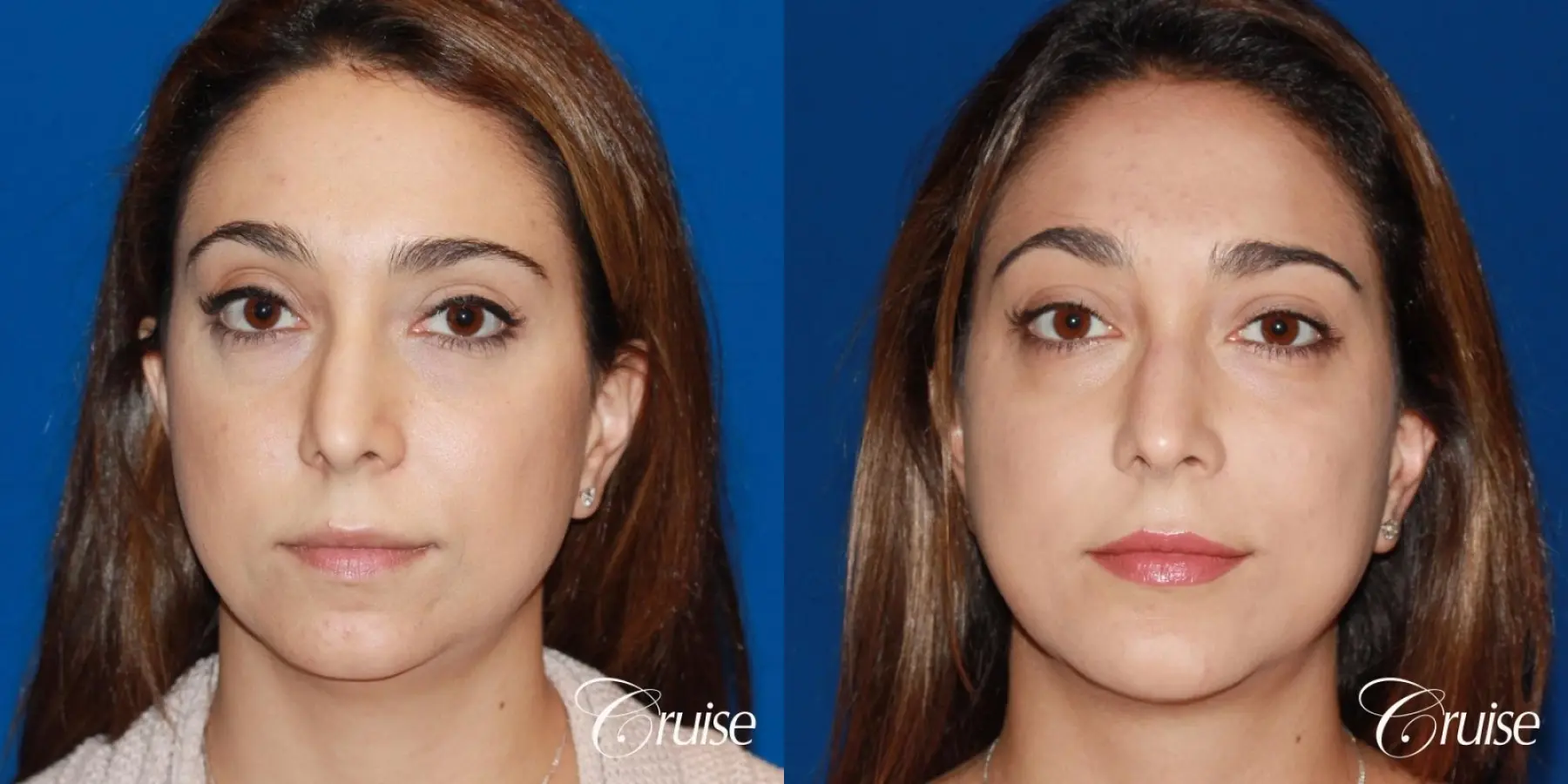 best medium chin implant on young patient - Before and After 1