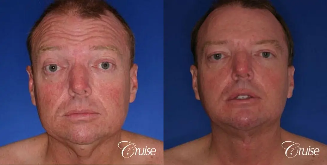 best male chin implant with large square jaw - Before and After 1