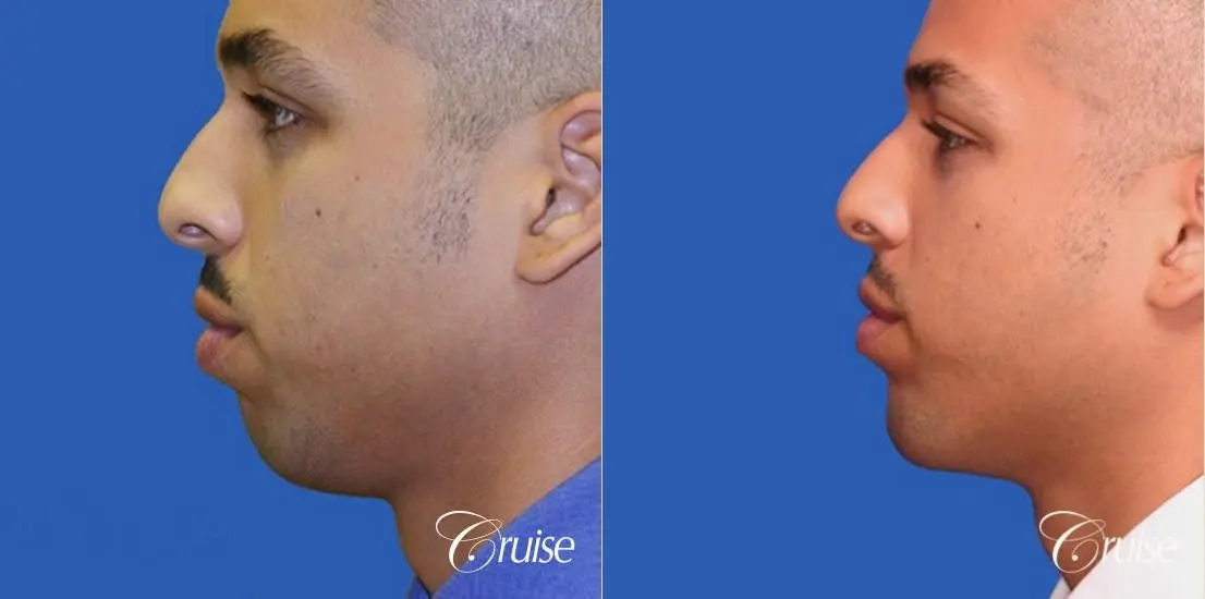 male patient with best pictures of chin implant - Before and After 2