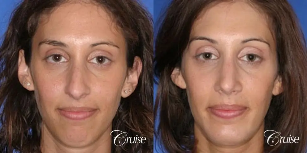 29 yr old with large female chin augmentation - Before and After 1