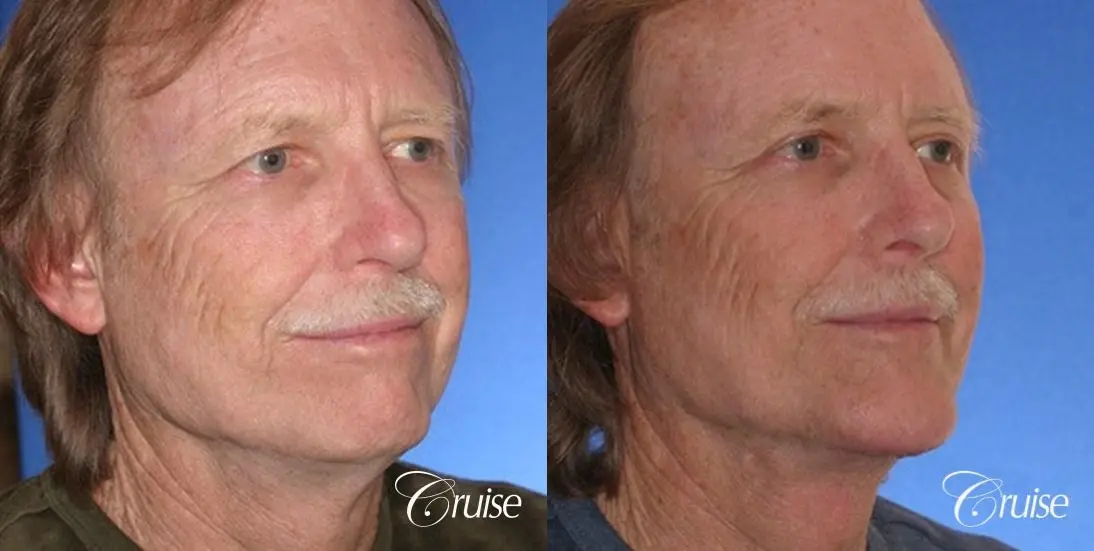 62 yr old with medium square chin augmentation - Before and After 3