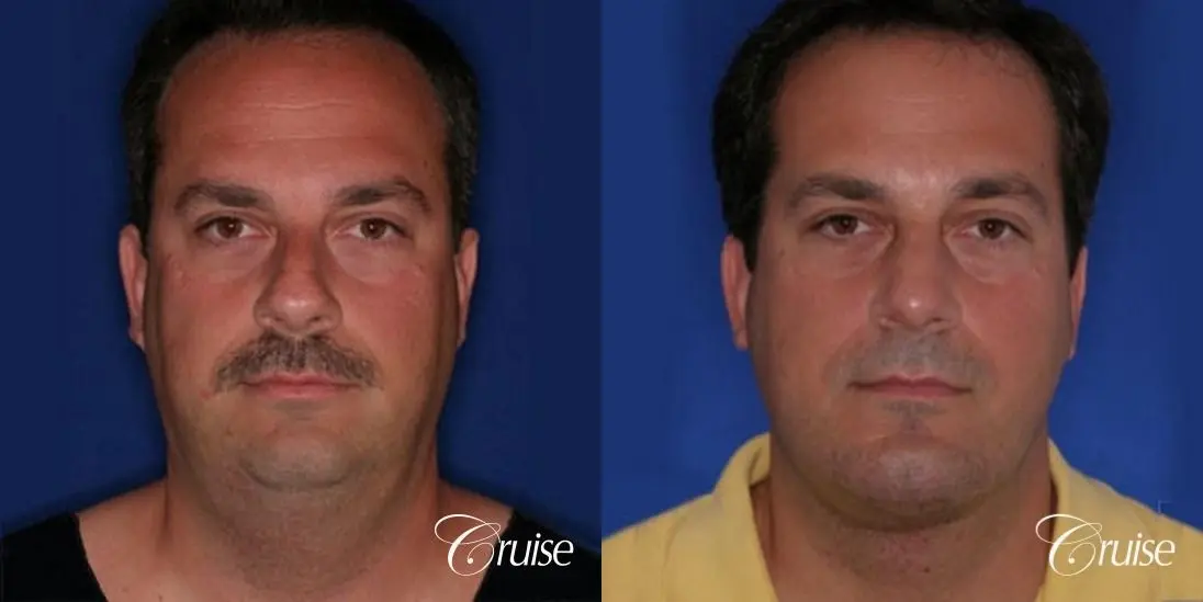 terino square jaw implant after best chin augmentation - Before and After 1