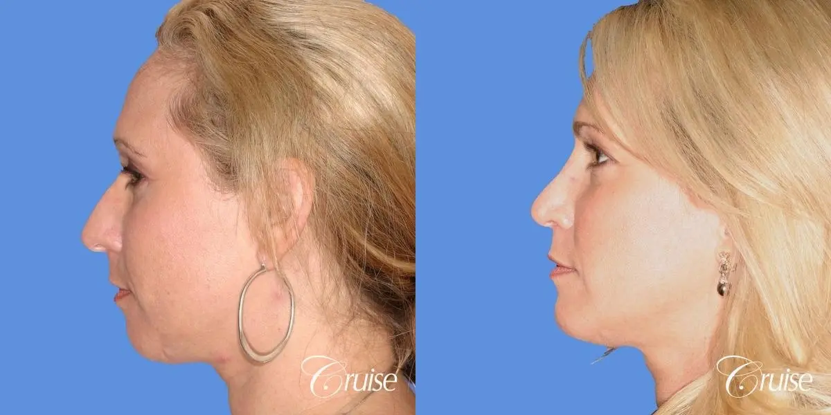 female with natural looking chin implant - Before and After 2