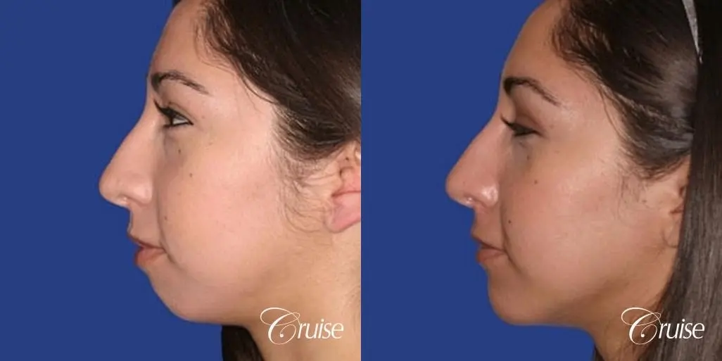 anatomic chin implant with top plastic surgeon in Newport Beach - Before and After 2
