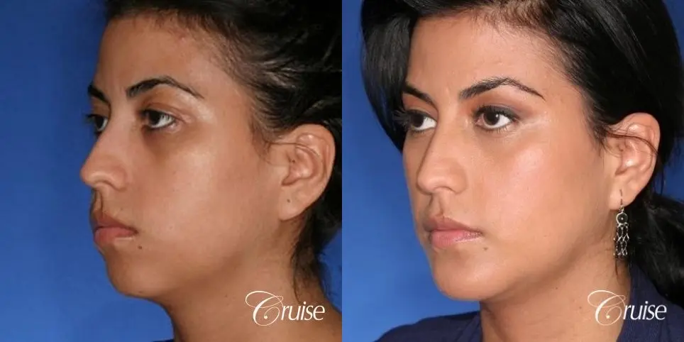 best XL chin implant on female patient - Before and After 3