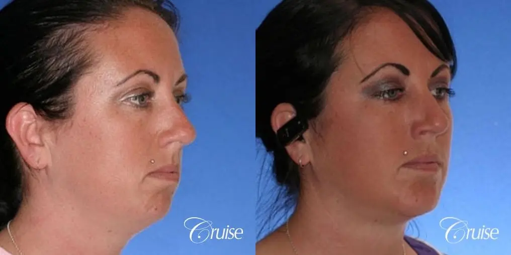 before and after photos of female chin implant - Before and After 3