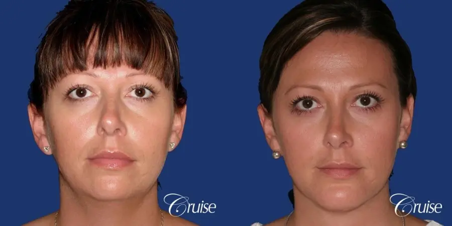 best before and after of chin augmentation medium implant - Before and After