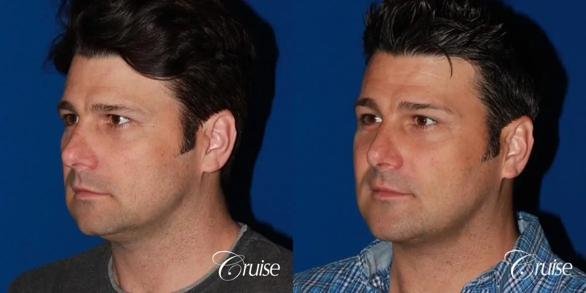 best medium terino square implant before and after pictures - Before and After 3